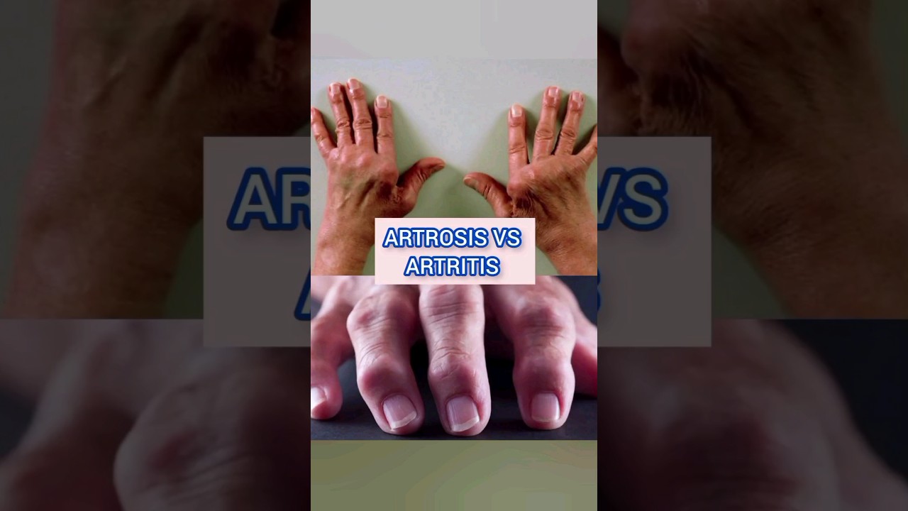 artrosis en los dedos de los pies sintomas