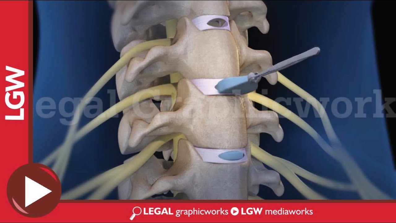 baja por hernia discal cervical c5 c6