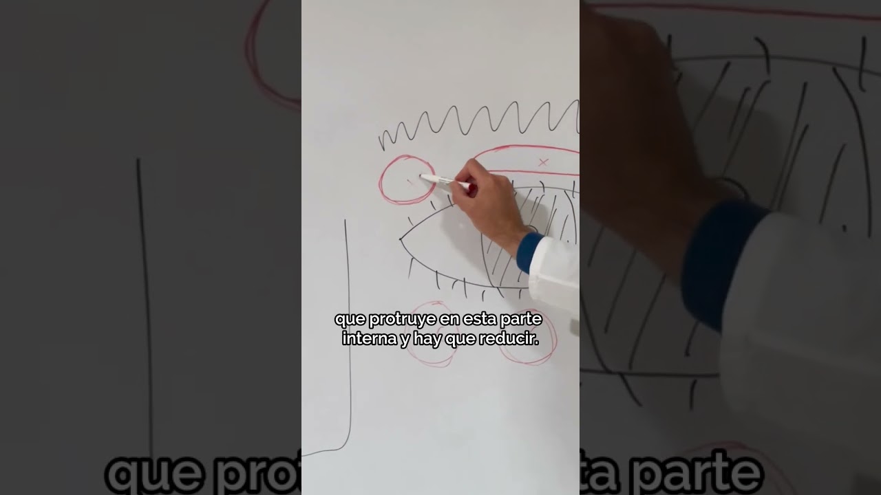 bolsas de grasa en los ojos