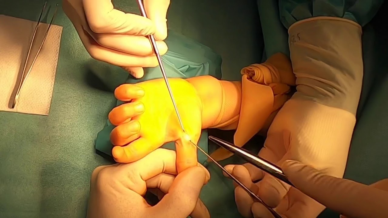 cirugia de dedo pulgar en gatillo
