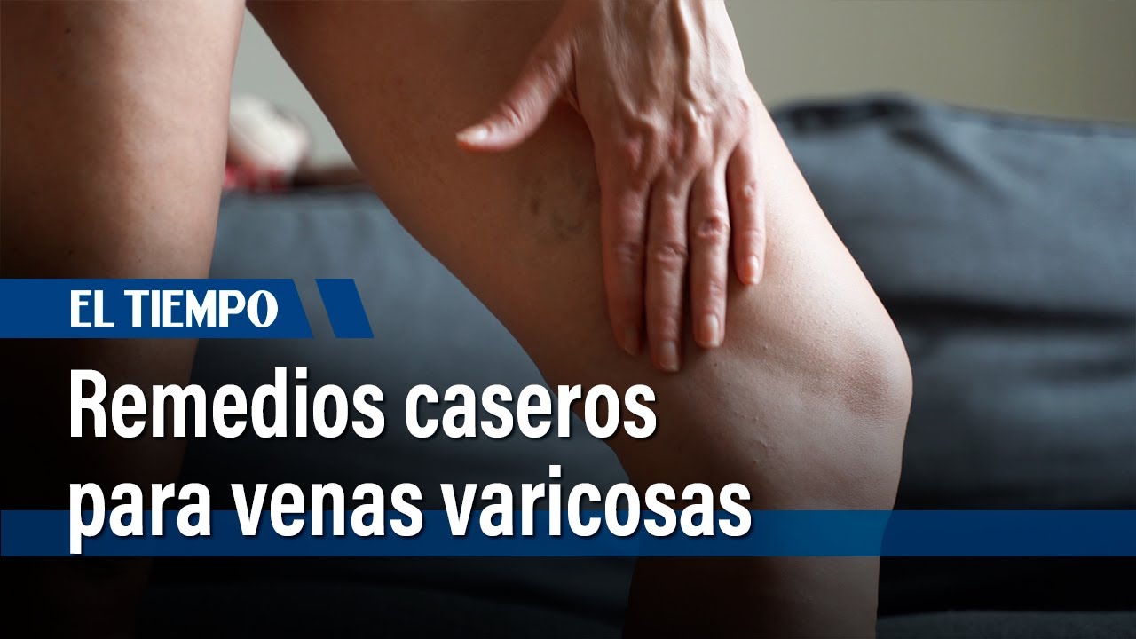 cómo aliviar el dolor de las varices pélvicas