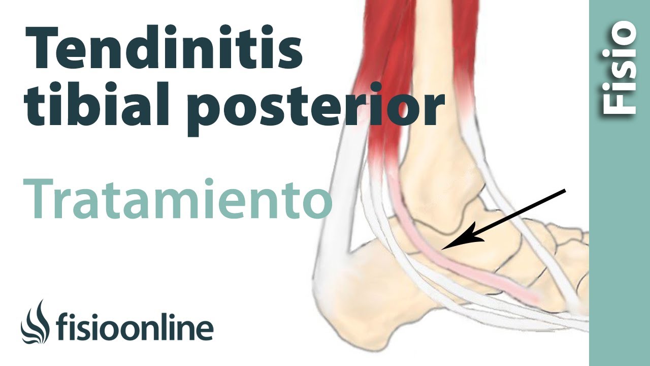 como curar la tendinitis tibial posterior