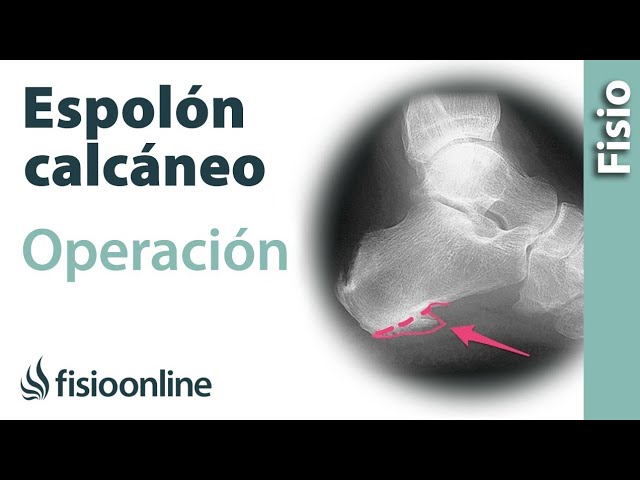 costo de operacion de espolon calcaneo
