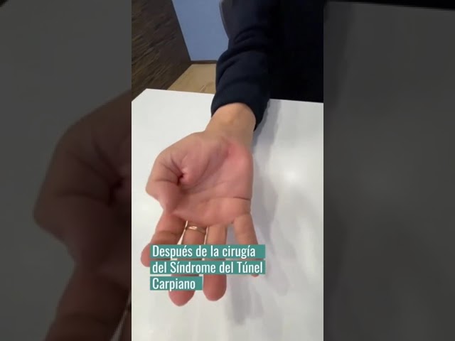 cuando operar el sindrome del tunel carpiano