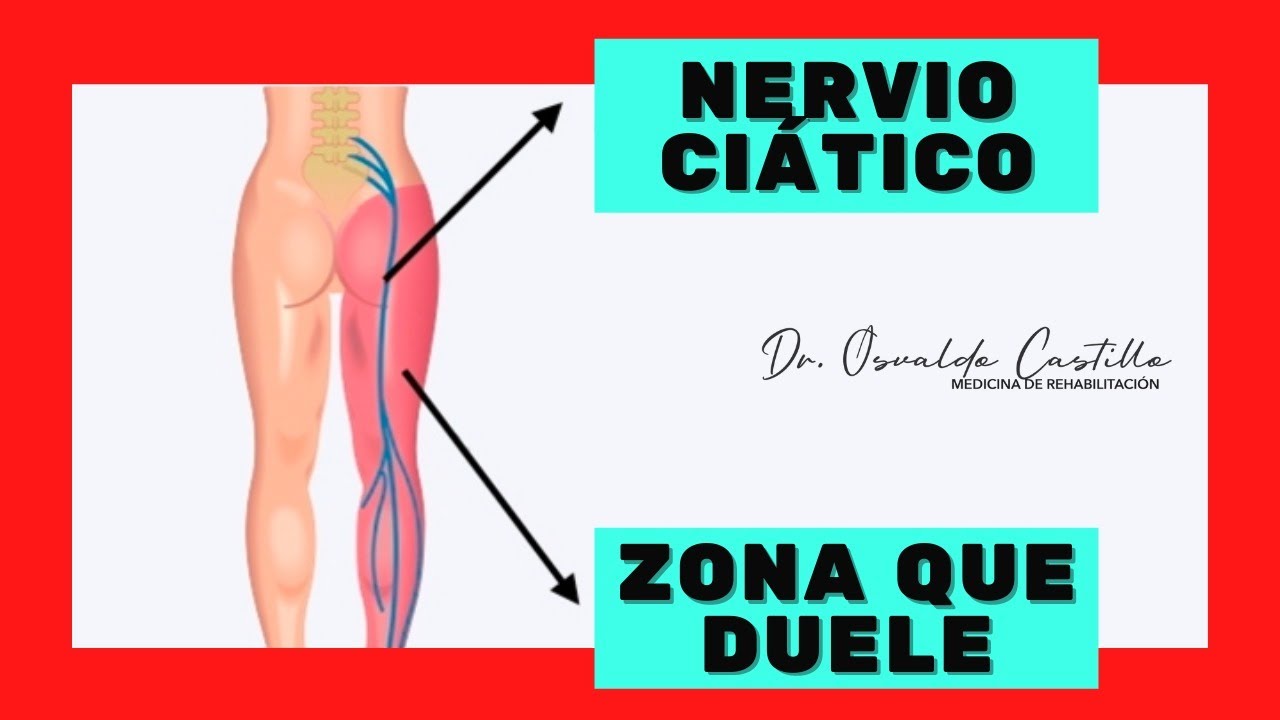 cuanto tiempo puede durar el dolor del nervio ciático