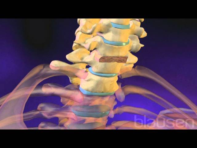 defecto de fusion del arco posterior s1