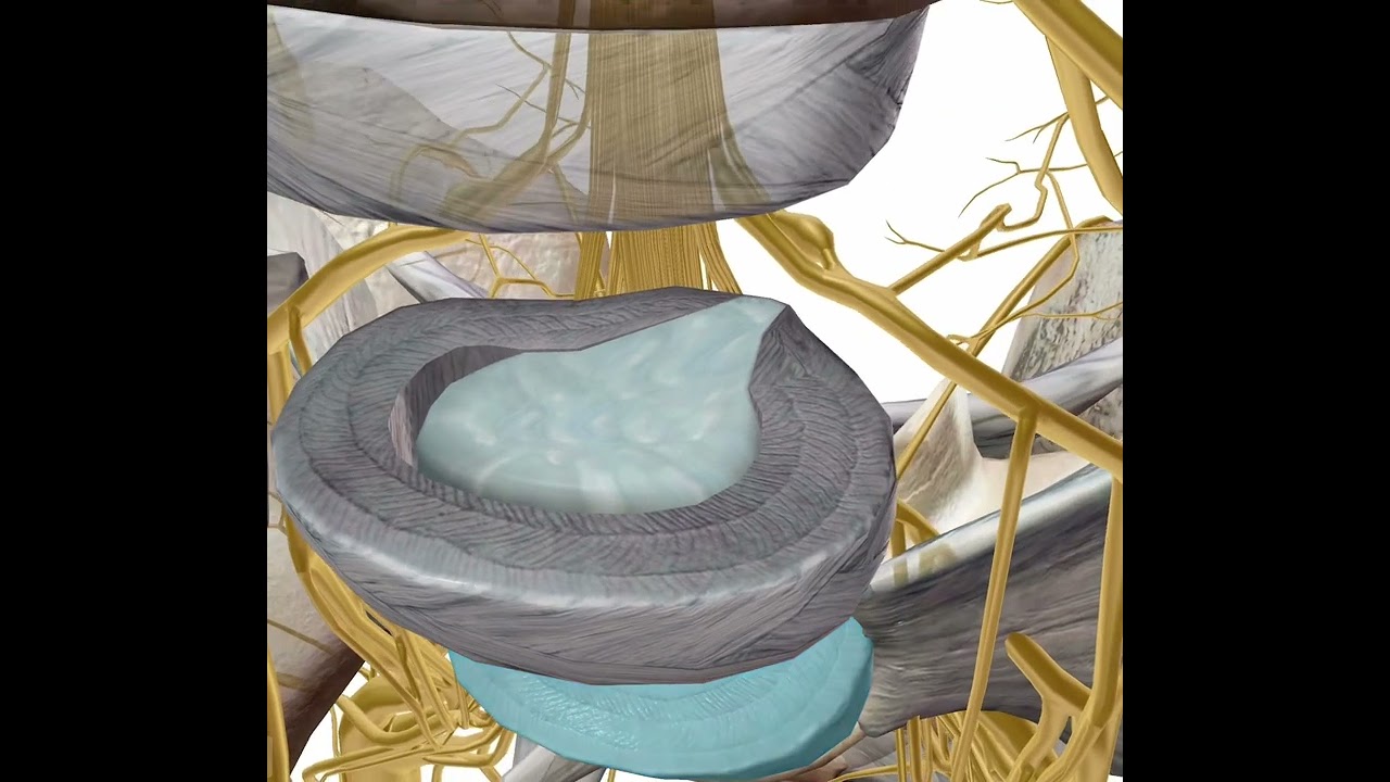 diferencia entre protusion discal y hernia discal