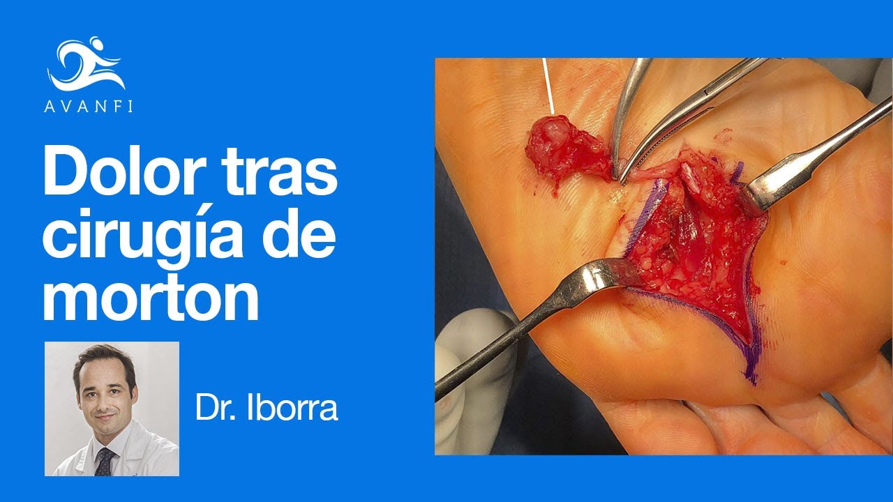 efectos secundarios operacion neuroma de morton