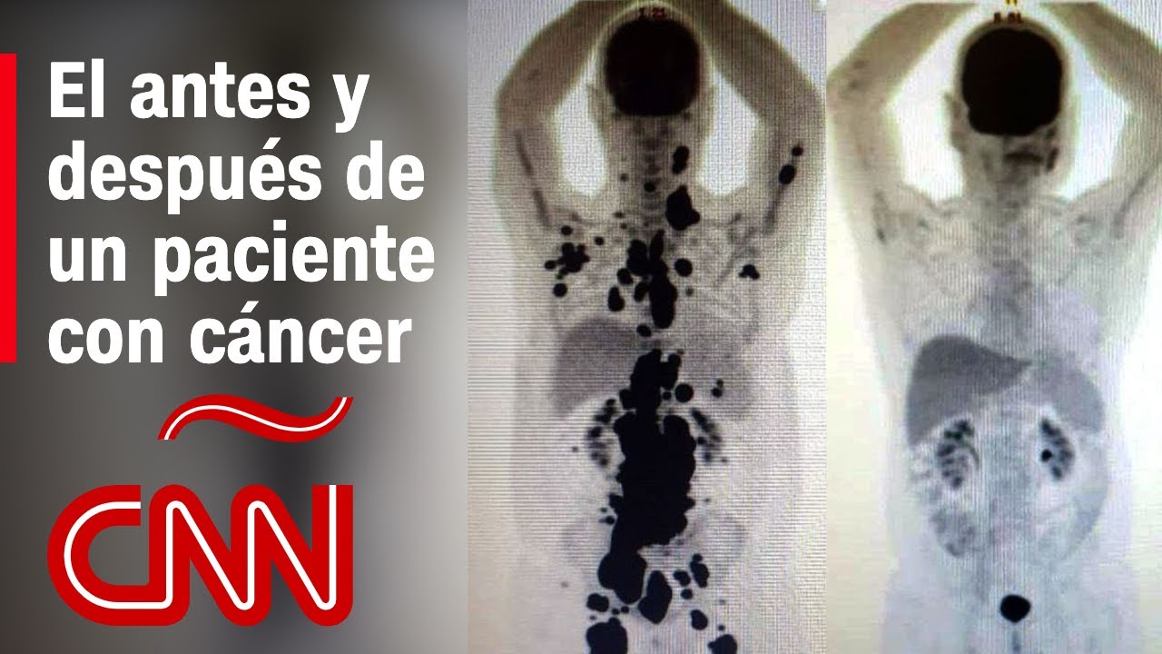 el paciente que curo a su terapeuta