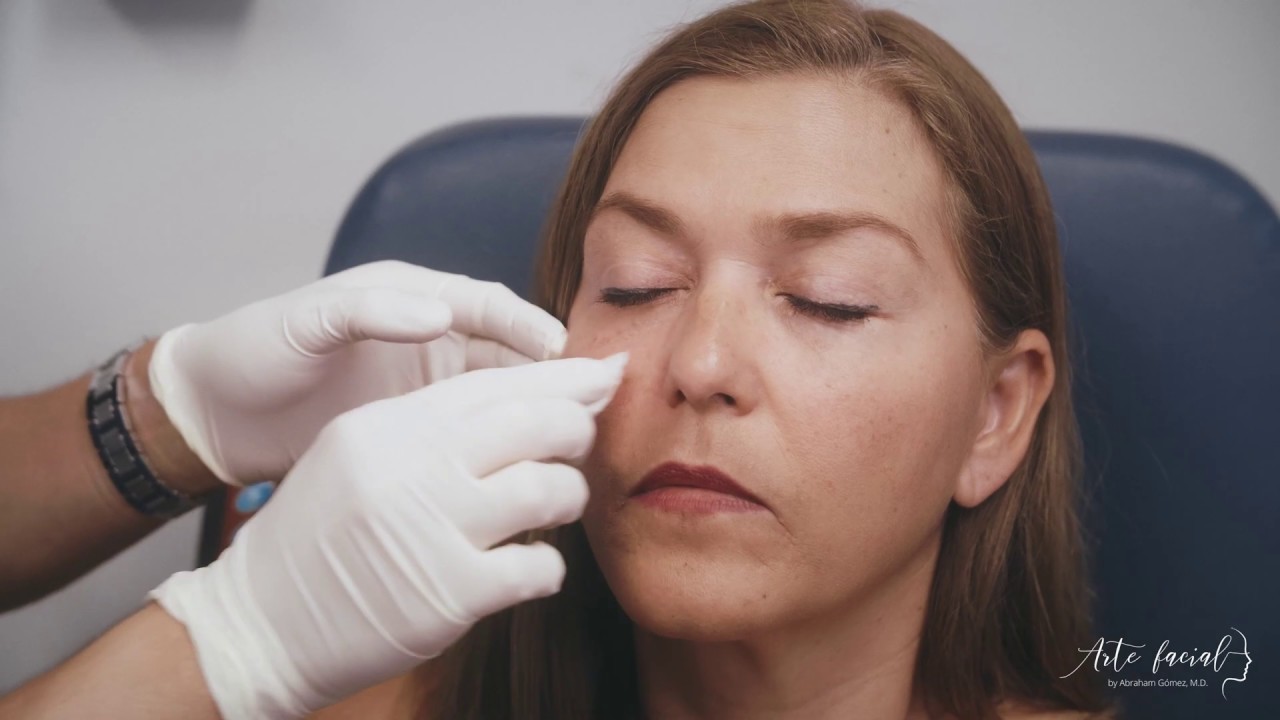 eliminar bolsas en los ojos con acido hialuronico
