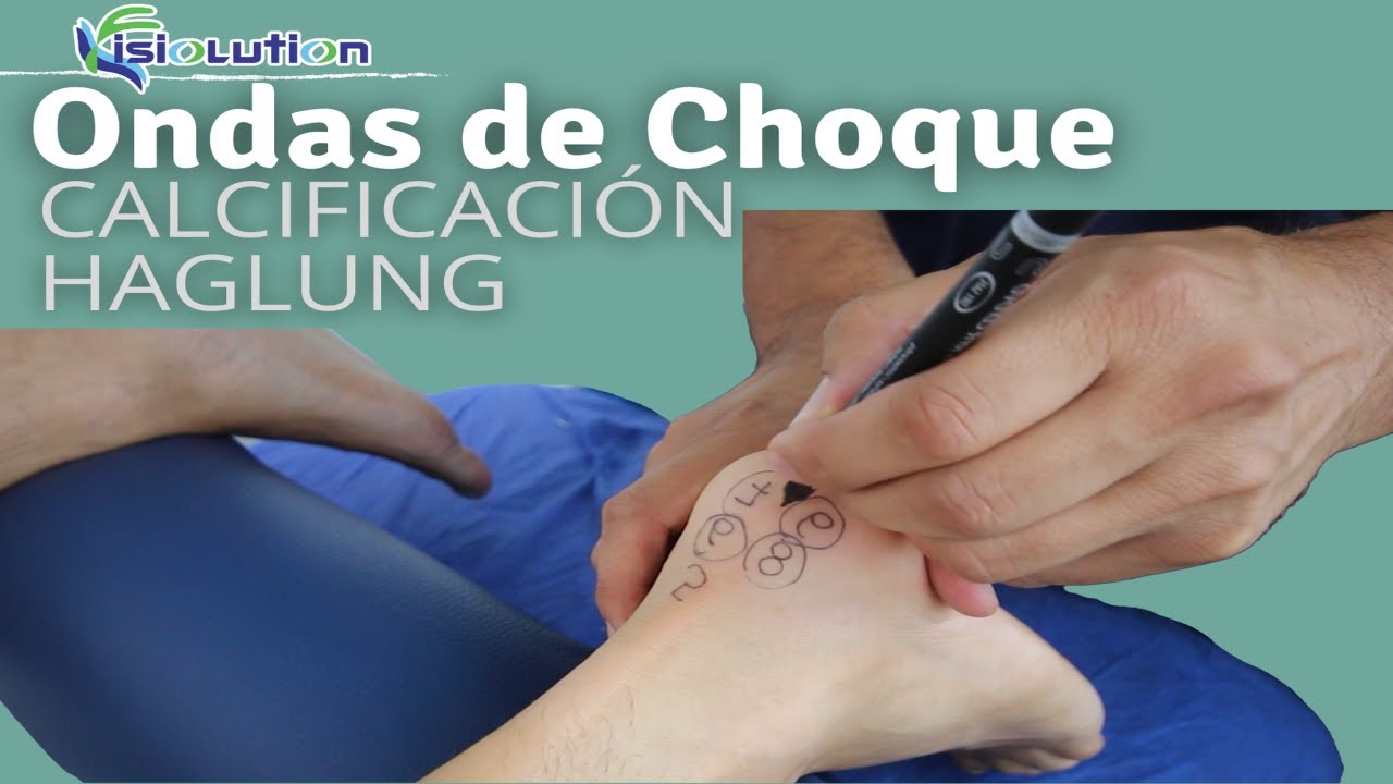 enfermedad de haglund ondas de choque