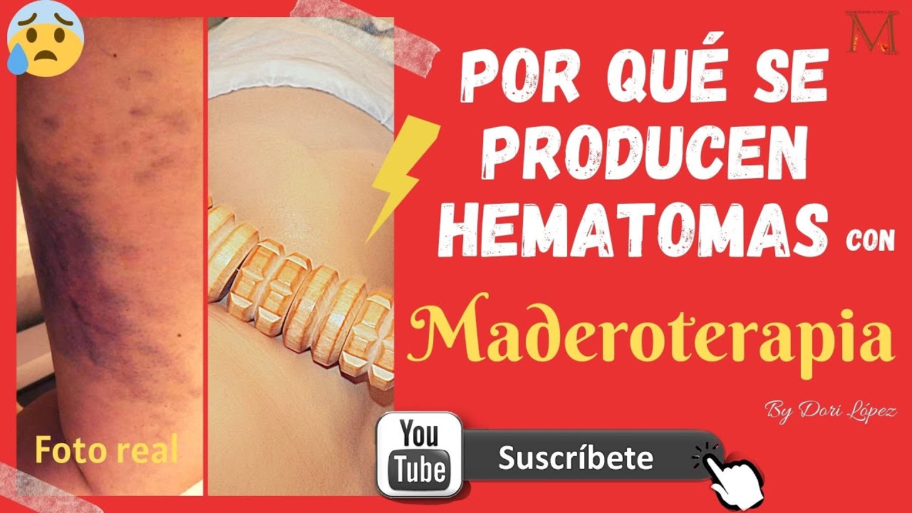 es normal que salgan moretones despues de un masaje