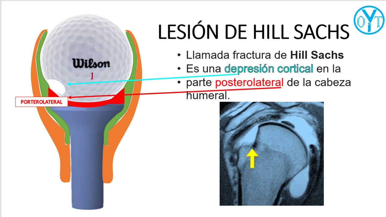 fractura de hill sachs y bankart