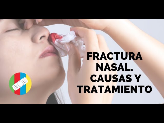 fractura de huesos propios sin desplazamiento
