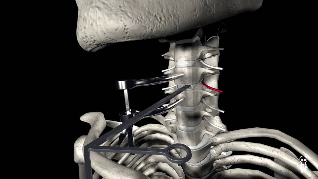 hernia de disco cervical c5 c6