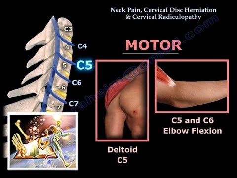 hernia discal cervical c5 c6 c6 c7