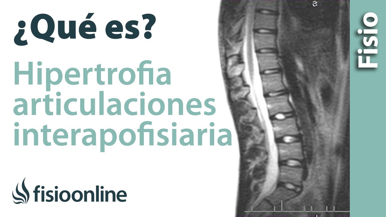 hipertrofia de facetas articulares l5 s1