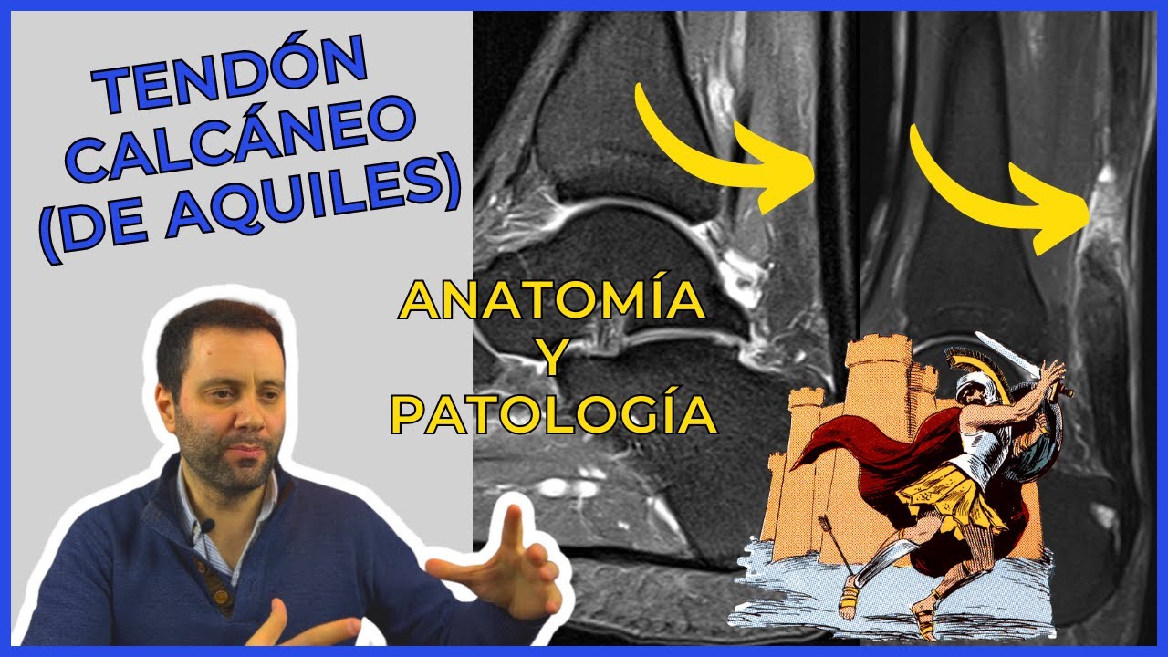 insercion del tendon de aquiles en el calcaneo