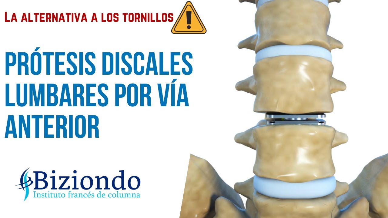 los tornillos puestos por una artrodesis lumbar son para siempre