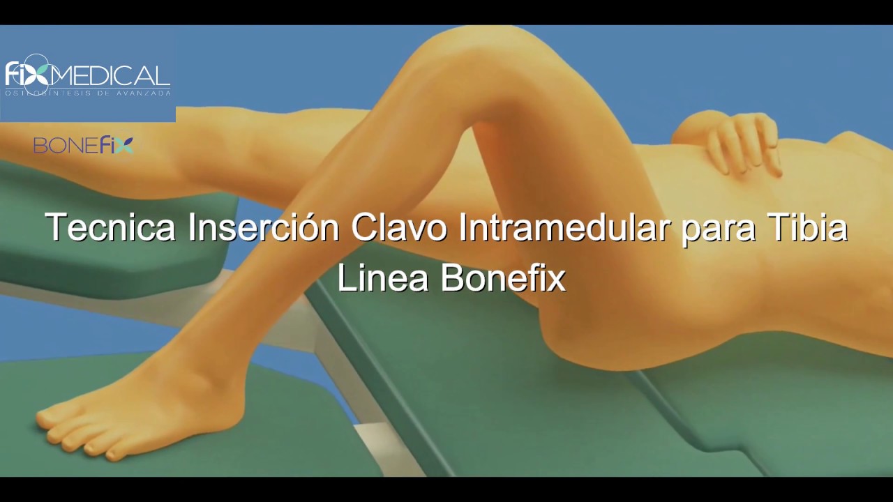 operacion de tibia y perone con clavo intramedular