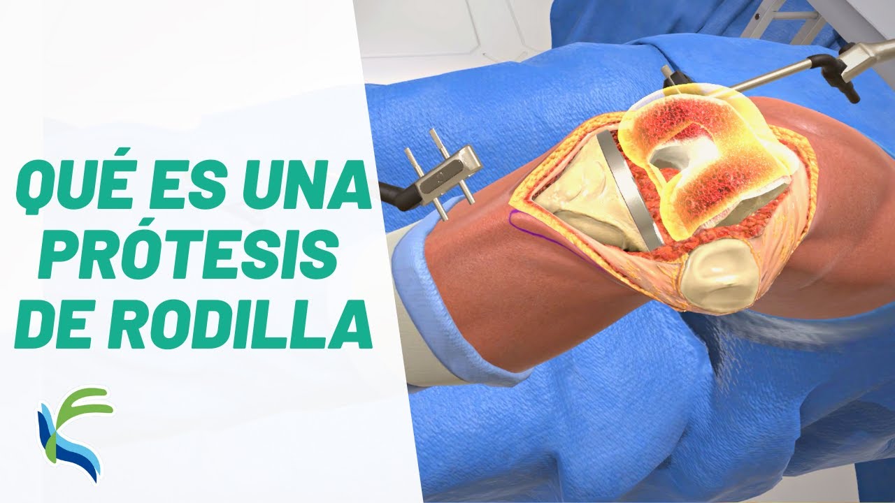 operacion protesis de rodilla tiempo de recuperacion
