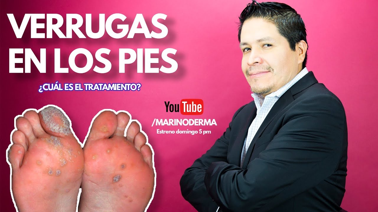 punto negro doloroso en la planta del pie