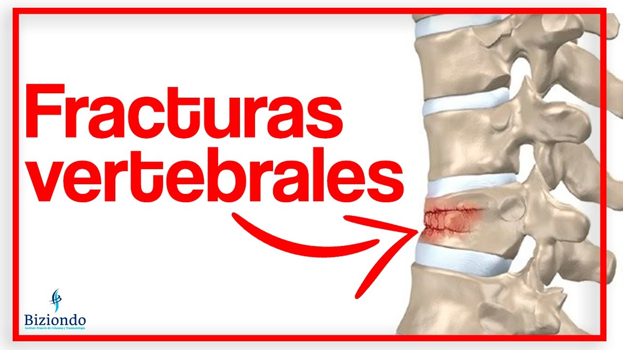 qué es un aplastamiento de vértebras