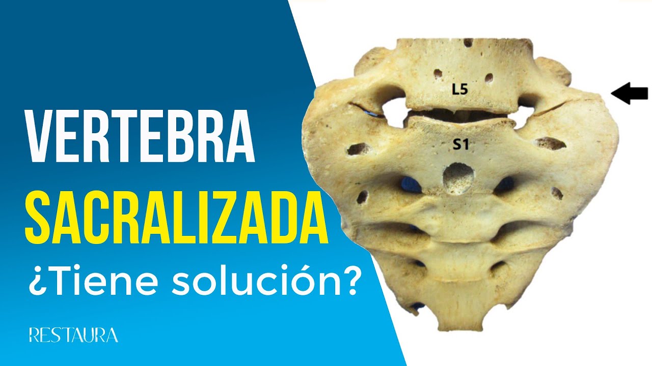 que significa hemisacralización izquierda de l5