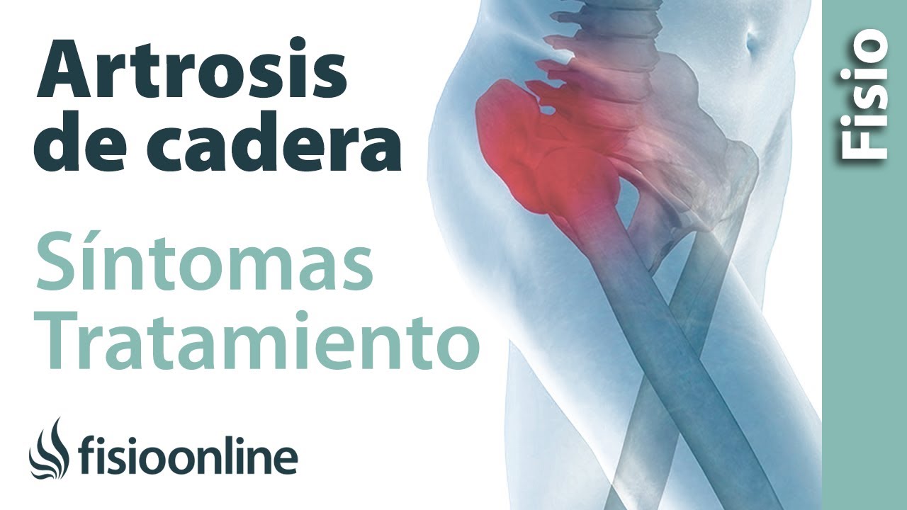 que sintomas presenta la artrosis de cadera