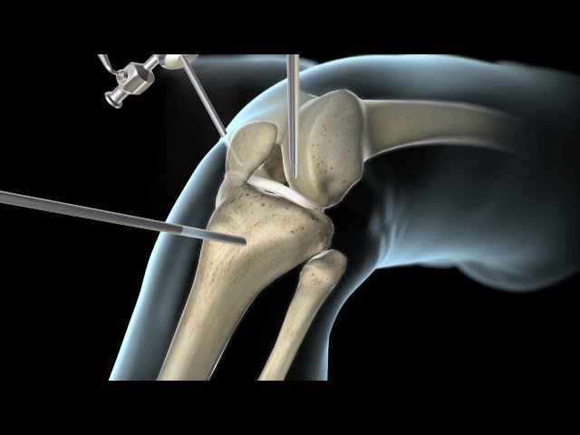 recuperacion de operacion de ligamento cruzado anterior y menisco