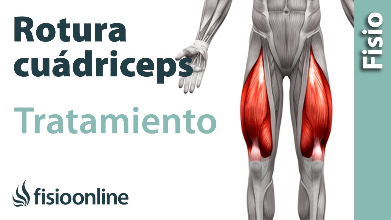 rotura de fibras en el cuadriceps