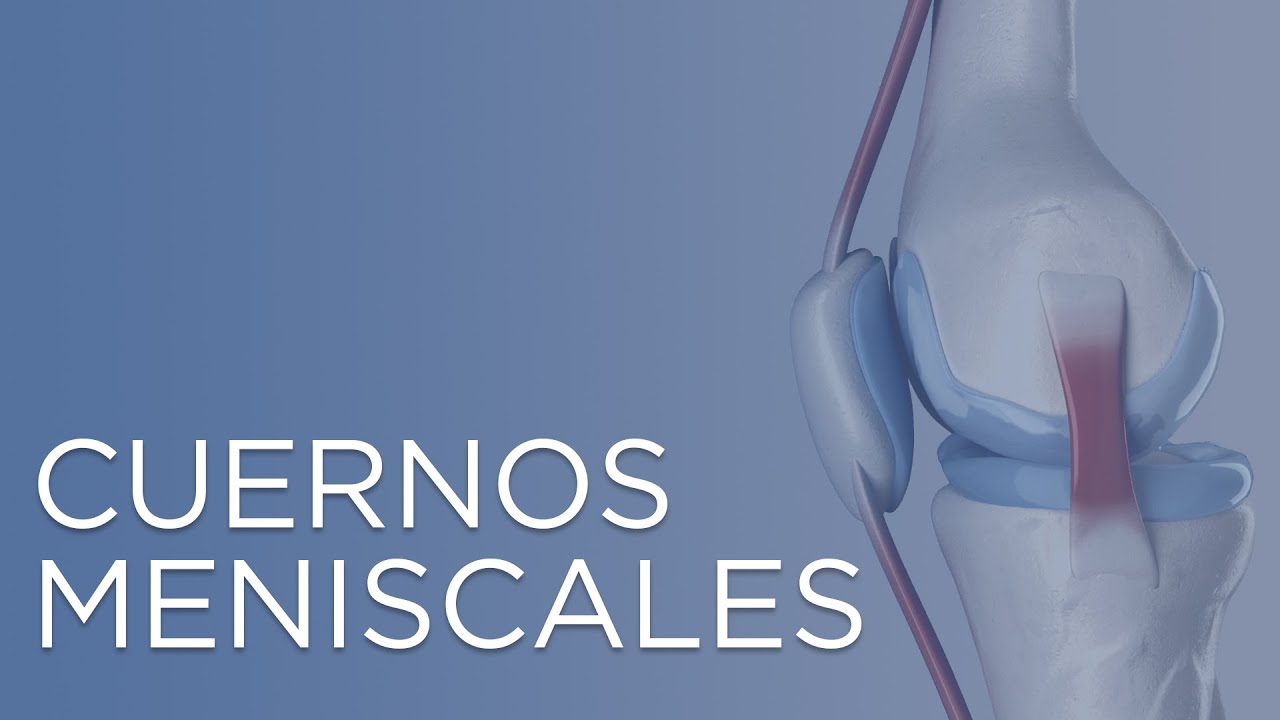 rotura del asta posterior del menisco interno