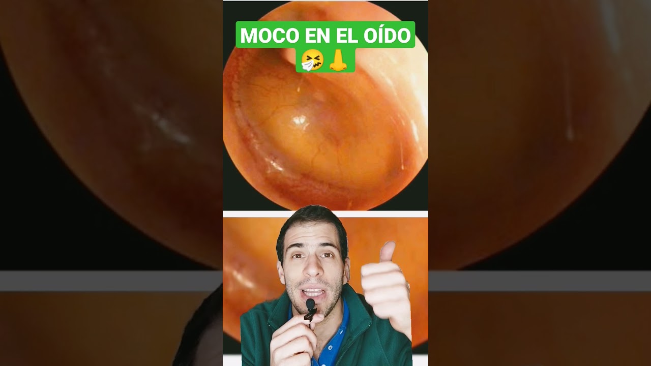 ruido en los oidos por mocos