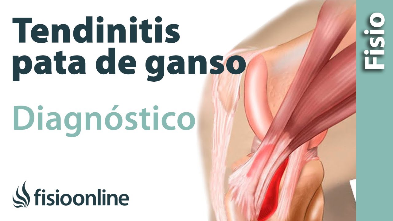 se puede operar la tendinitis pata de ganso