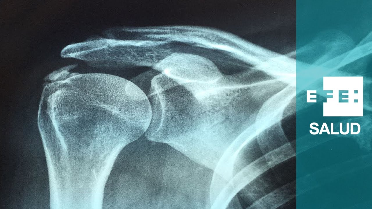 tendinitis con calcificacion en el hombro