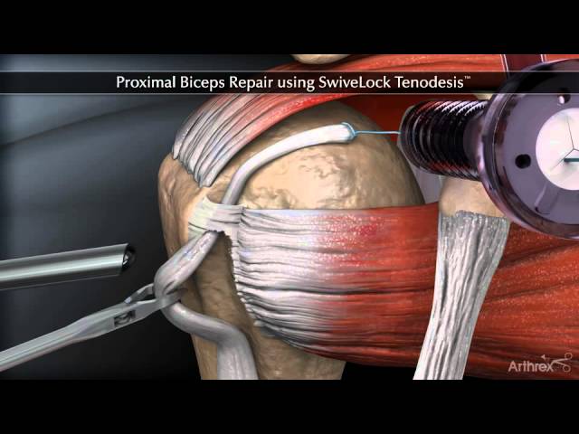 tendon de la cabeza larga del biceps braquial