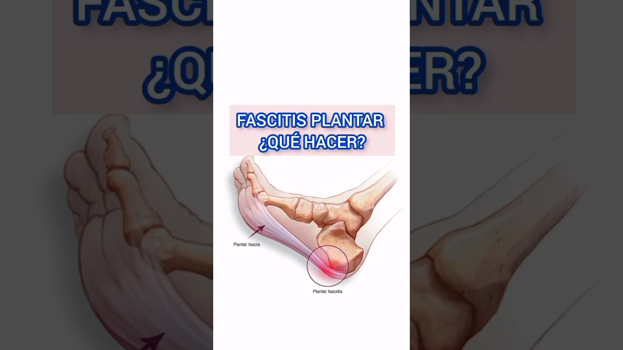 tiempo de baja laboral por fascitis plantar