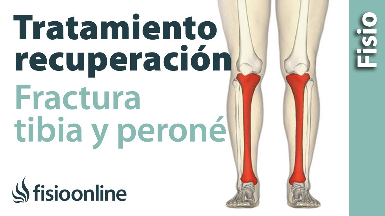 tratamiento para fractura de tibia y perone