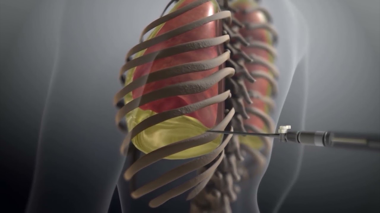 acumulacion de pus en la cavidad pleural