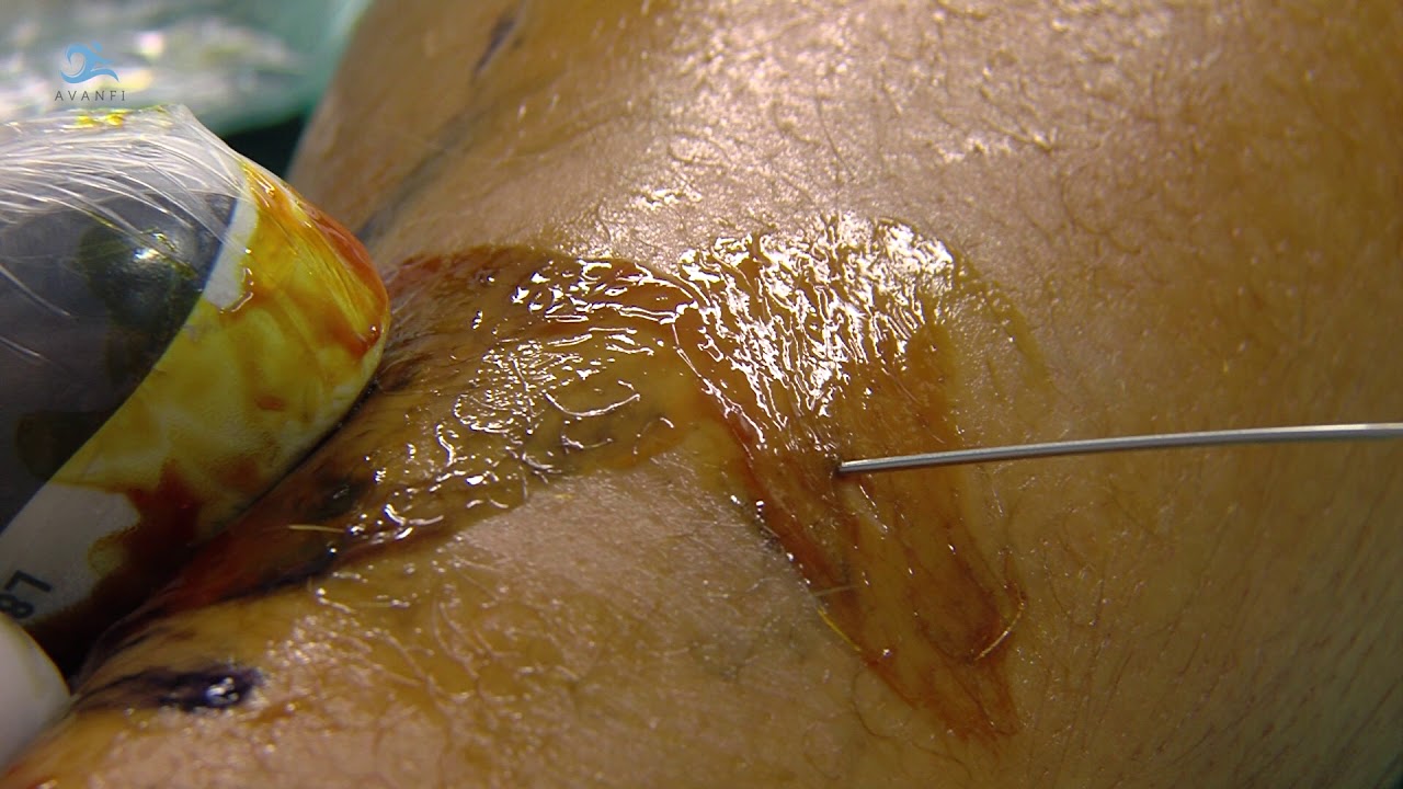 alargamiento de tendon de aquiles en niños