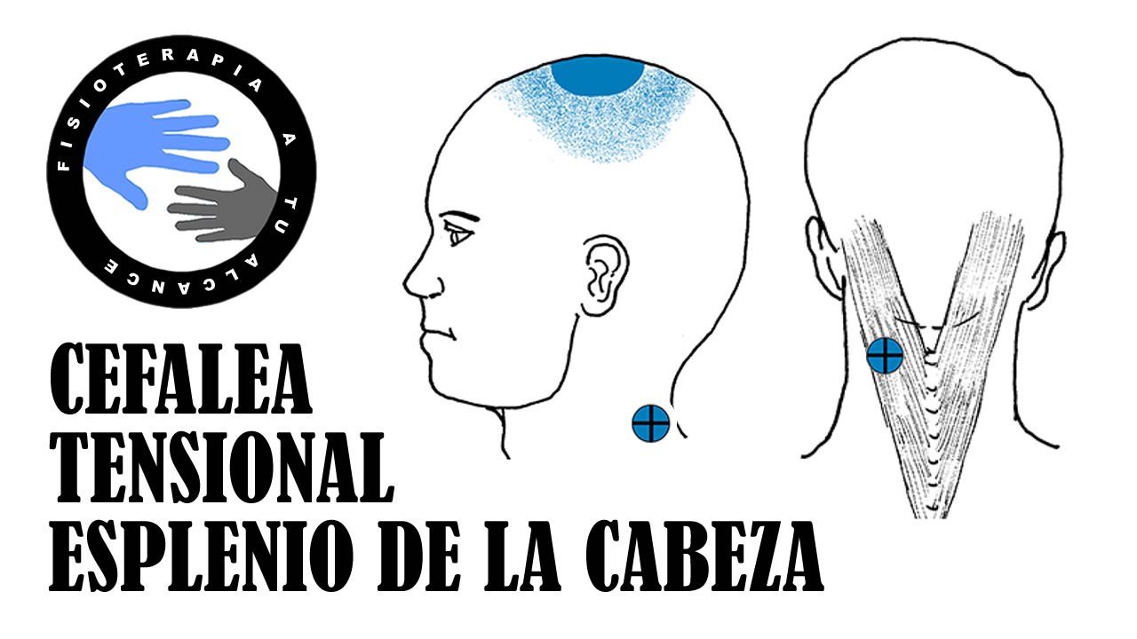 cefalea tensional esplenio de la cabeza