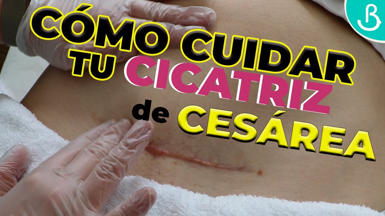 como cuidar la herida de una cesarea