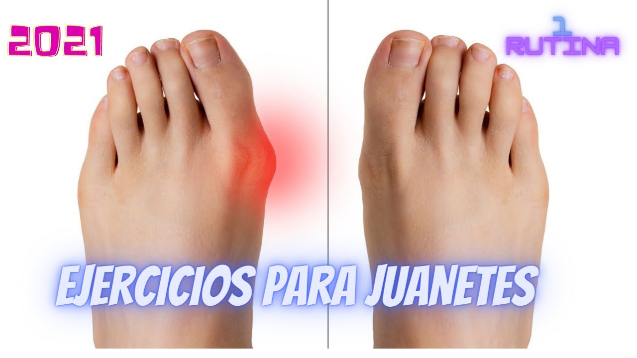 como curar los juanetes del dedo chiquito