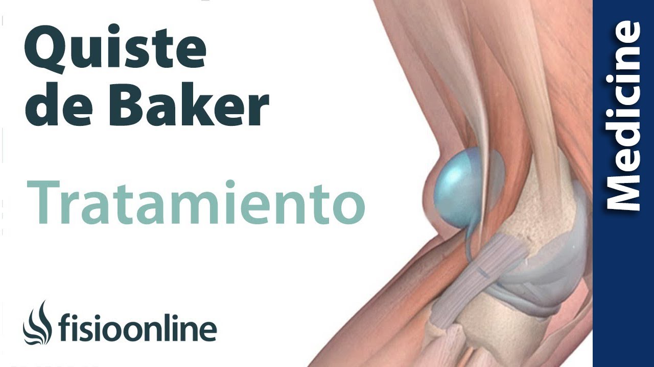 como tratar el quiste de baker