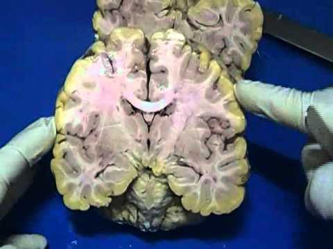 corte coronal del cerebro y sus partes