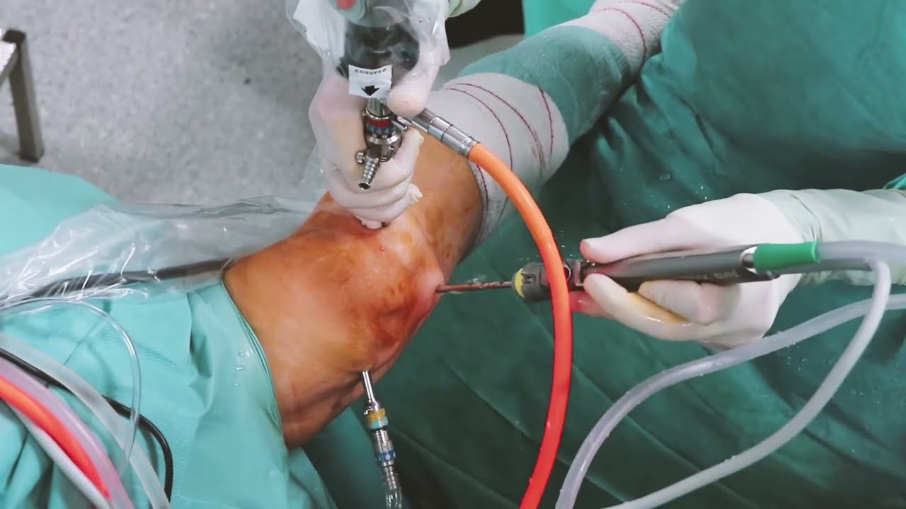 cuanto sale una operacion de meniscos en chile