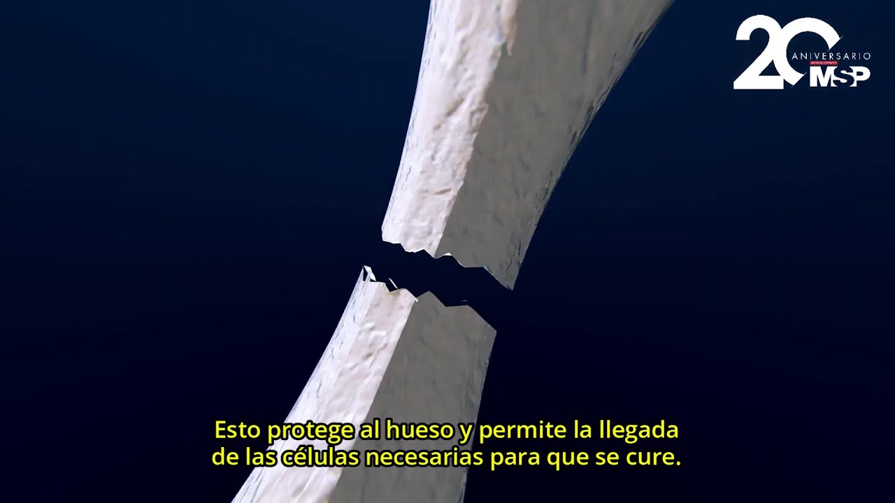 cuanto tarda un injerto de hueso en soldar