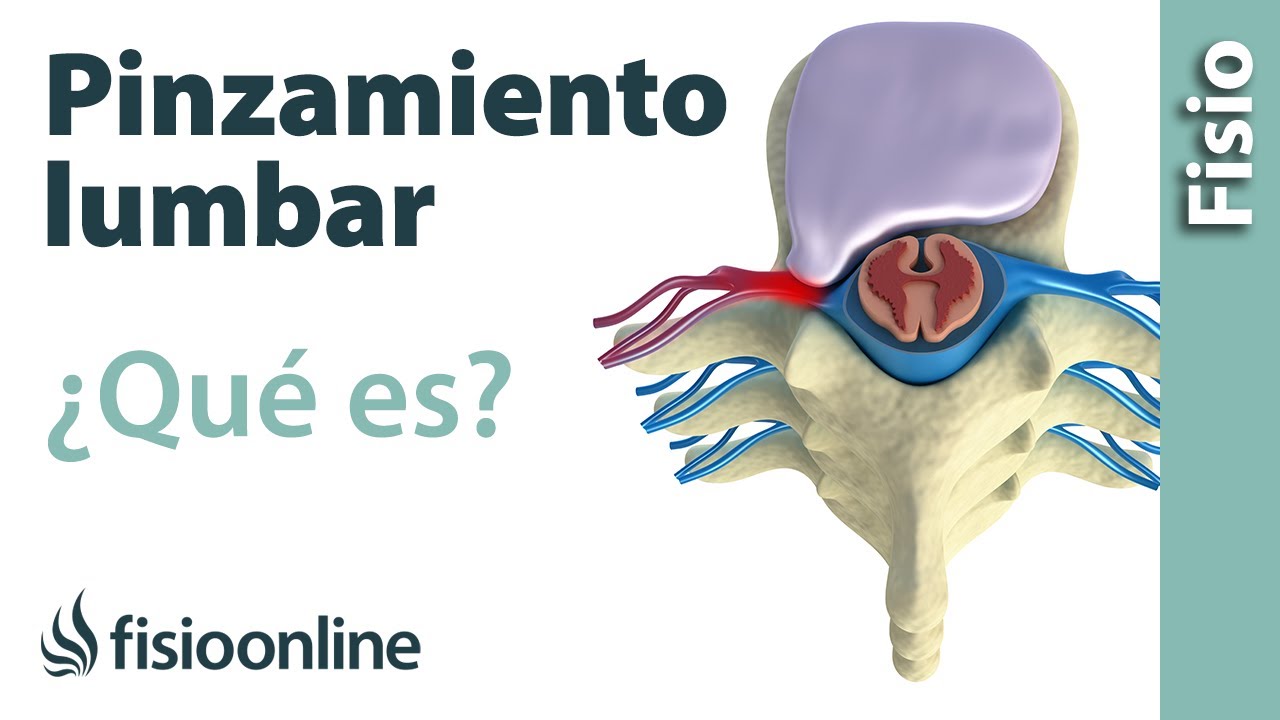 diferencia entre hernia discal y pinzamiento