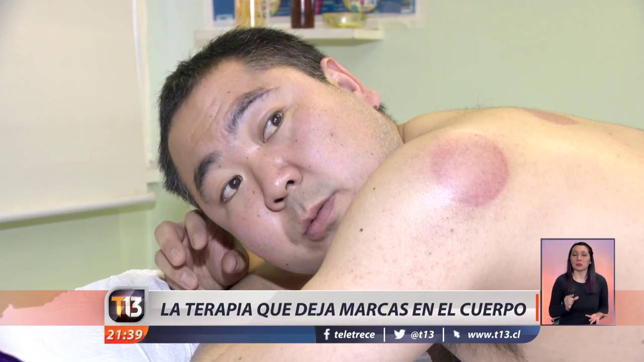 efectos de las ventosas para el cuerpo