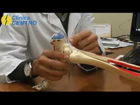 entesopatia insercional del tendon de aquiles